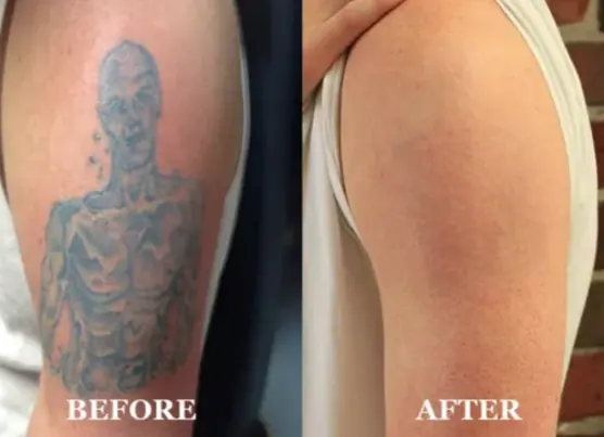 Laser Tattoo Removal